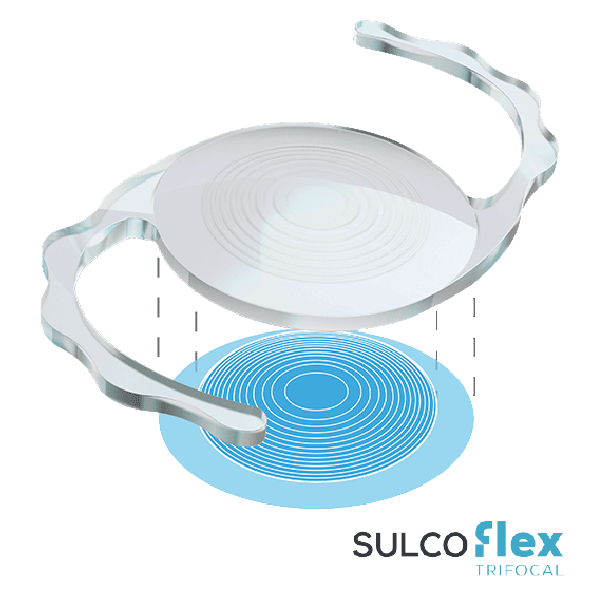 LIO suplementaria Sulcoflex®  Trifocal